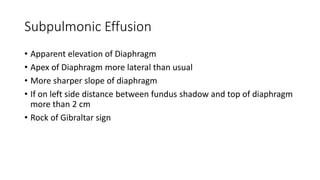 Subpulmonic Effusion
• Apparent elevation of Diaphragm
• Apex of Diaphragm more lateral than usual
• More sharper slope of diaphragm
• If on left side distance between fundus shadow and top of diaphragm
more than 2 cm
• Rock of Gibraltar sign
 