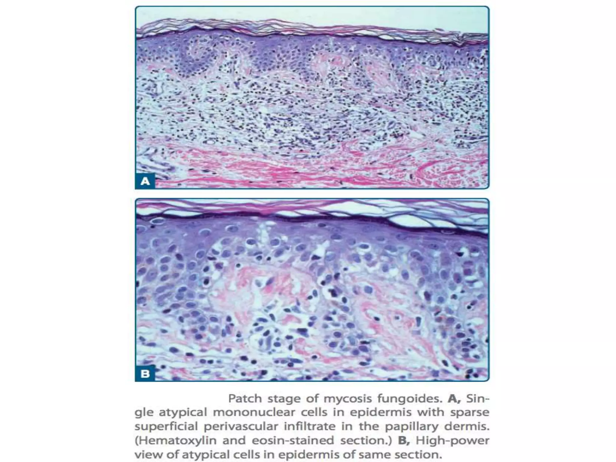 Cutaneous T Cell Lymphomas | PPTX