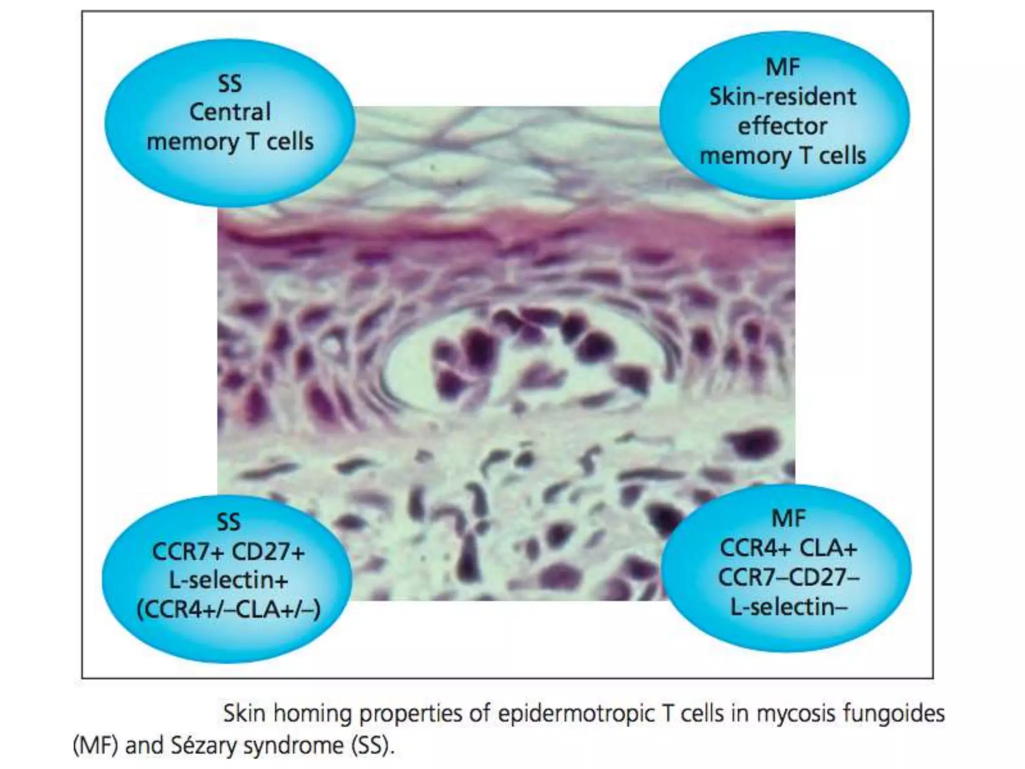 Cutaneous T Cell Lymphomas | PPTX