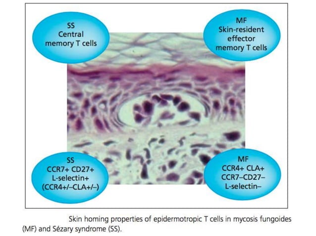 Cutaneous T Cell Lymphomas | PPTX