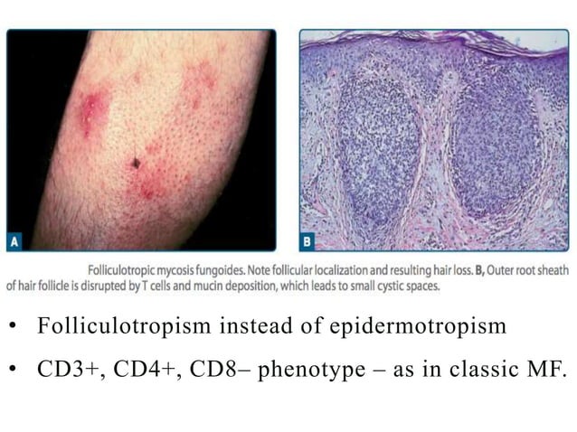 Cutaneous T Cell Lymphomas | PPTX