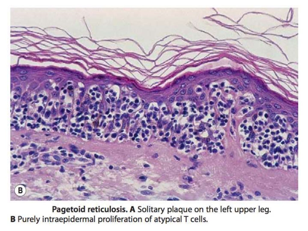 cutaneous tcel lymphoma cutaneous tcel lymphoma