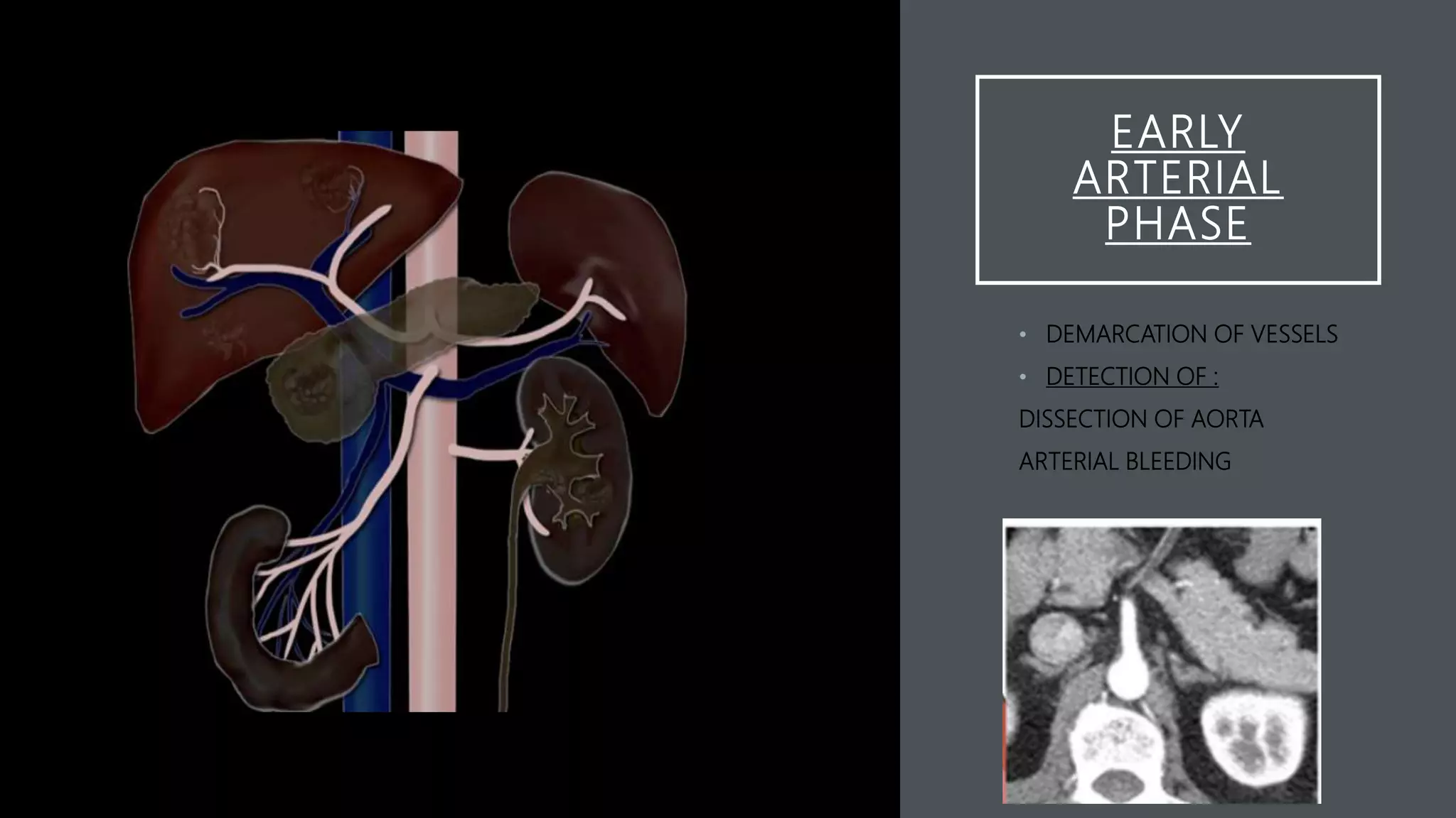 EARLY
ARTERIAL
PHASE
• DEMARCATION OF VESSELS
• DETECTION OF :
DISSECTION OF AORTA
ARTERIAL BLEEDING
 