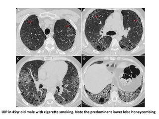 UIP in 45yr old male with cigarette smoking. Note the predominant lower lobe honeycombing
 