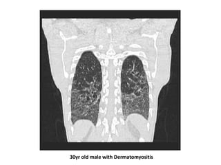 30yr old male with Dermatomyositis
 