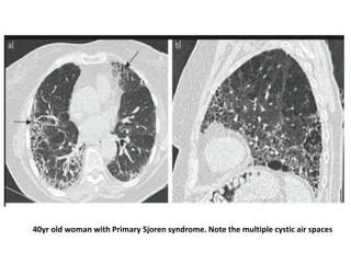 40yr old woman with Primary Sjoren syndrome. Note the multiple cystic air spaces
 