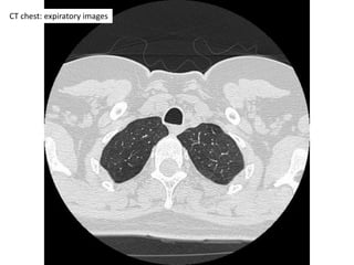 CT chest: expiratory images
 