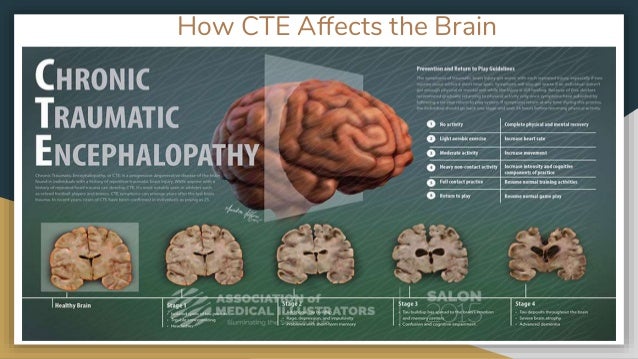 Cte : Scientists identify brain inflammation and CTE connection