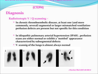 Chronic Thromboembolic Pulmonary artery Hypertension | PPT