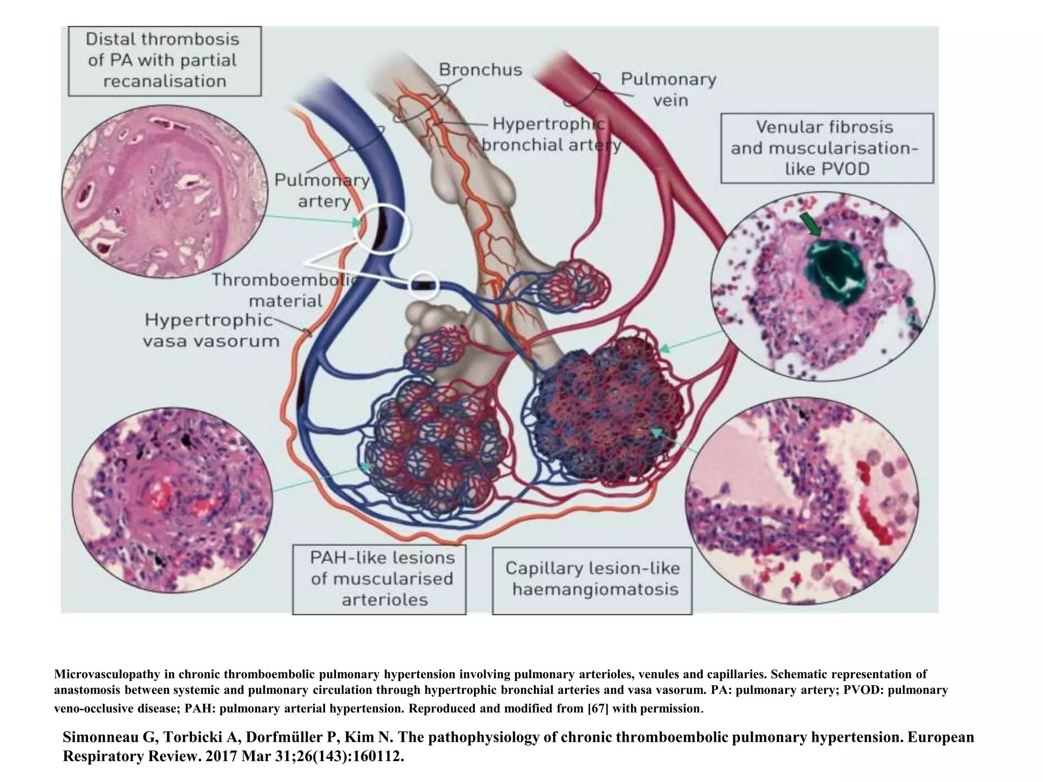 Chronic thromboembolic pulmonary hypertension (CTEPH) | PPT