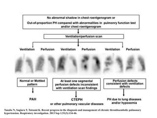 Chronic thromboembolic pulmonary hypertension (CTEPH) | PPTX