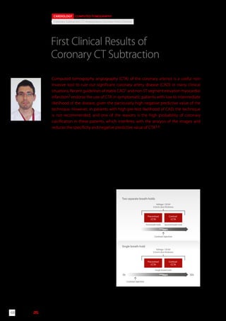 stented arteries. Coronary Subtraction can be performed
in two breath-hold or in a single breath-hold (Figure 1).
The non-contrast CTA volume is then subtracted
from the contrast-enhanced CTA volume, removing
the calcium/metallic content of coronary arteries. To
obtain an accurate registration of two volumes and
minimize misregistration artefacts, the single breath-
hold methodology was chosen. After pre-oxygenation
with low-flow oxygen and immediately after contrast
injection, a non-contrast scan and a contrast scan with
The introduction of Aquilion ONE™ 320-row CT scanner,
and later the Aquilion ONE™/ ViSION Edition with a
maximum fastest rotation time of 0.275s, have it made
possibletoobtainanon-invasivecoronaryangiographyin
asingleheartbeatandseveralstudieshavedemonstrated
its high diagnostic accuracy in the depiction of epicardial
coronary stenotic lesions7,8. Despite technological
advances in CT, improving both spatial and temporal
resolution, there are still several limitations due to
increased heart rate, presence of small stents (less than
3 mm diameter), or extensive coronary artery
calcification. Recently, Toshiba has developed
a new application (Coronary Subtraction) to
allow the subtraction of calcium and metal
stents in the coronary arteries to improve
the diagnostic performance in these clinical
scenarios.
Coronary subtraction CT requires two
scans,onepre-contrastandonepost-contrast.
The subtraction of three-dimensional (3D)
CTA volumes is significantly more challenging
than the two-dimensional (2D) subtraction
performed in X-Ray digital subtraction
angiography (DSA). Subtraction in two
dimensions only requires shifting of the mask
image in two axes: x and y. In 3D volumes,
not only manual shifting of the mask in three
axes (x,y and z), but also rotational movement
is required. The fact that the two studies
have to be performed consecutively implies
that respiratory, pulsatile and spatial motion
potential changes can lead to volumes of data
with somewhat different spatial relationships
between bony structures and calcified or
Precontrast
CCTA
Contrast
CCTA
Precontrast
CCTA
Contrast
CCTA
Voltage: 120 kV
0.5mm slice thickness
Voltage: 120 kV
0.5mm slice thickness
First breath-hold
Single breath-hold
Two separate breath-holds
Second breath-hold
Single breath-hold
Contrast injection
0s 30s
Contrast injection
SURE
Start
SURE
Start
First Clinical Results of
Coronary CT Subtraction
Computed tomography angiography (CTA) of the coronary arteries is a useful non-
invasive tool to rule out significant coronary artery disease (CAD) in many clinical
situations. Recent guidelines of stable CAD1 and non-ST segment elevation myocardial
infarction2 endorse the use of CTA in symptomatic patients with low to intermediate
likelihood of the disease, given the particularly high negative predictive value of the
technique. However, in patients with high pre-test likelihood of CAD, the technique
is not recommended, and one of the reasons is the high probability of coronary
calcification in these patients, which interferes with the analysis of the images and
reduces the specificity and negative predictive value of CTA3-6.
D. Viladés-Medel MD 1,2), R. Leta MD1,2), A. Hidalgo MD PhD 1,2), F. Carreras MD PhD 1,2), G. Pons-Lladó MD PhD 1,2),
X. Alomar MD 1)
CARDIOLOGY COMPUTED TOMOGRAPHY
Coronary Subtraction, CT Angiography, Coronary Artery Disease
1) Clinica Creu Blanca,
Barcelona
2) Unitat d’Imatge
Cardíaca Hospital de
Sant Creu i Sant Pau
Spain Figure 1: Image acquisition methodologies for CTA subtraction.
D. Viladés-Medel
©2014 TOSHIBA MEDICAL SYSTEMS68 | VISIONS25
 