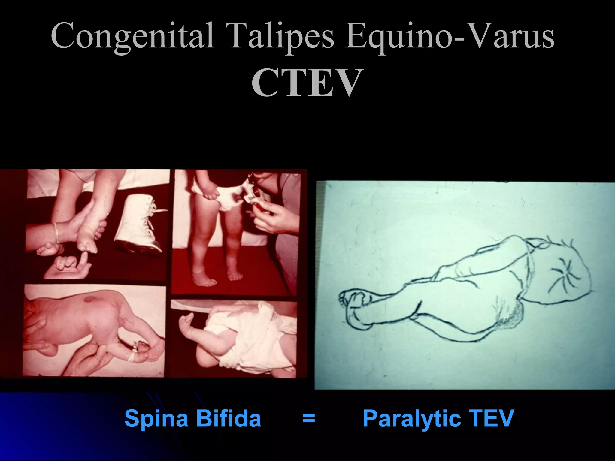 CONGENITAL TALIPES EQUINO VARUS | PPT