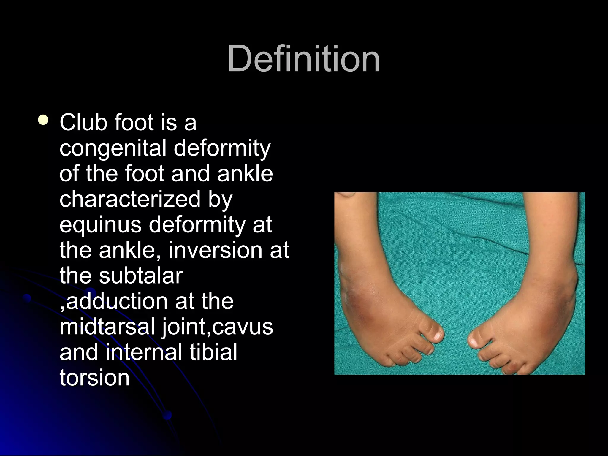 CONGENITAL TALIPES EQUINO VARUS | PPT