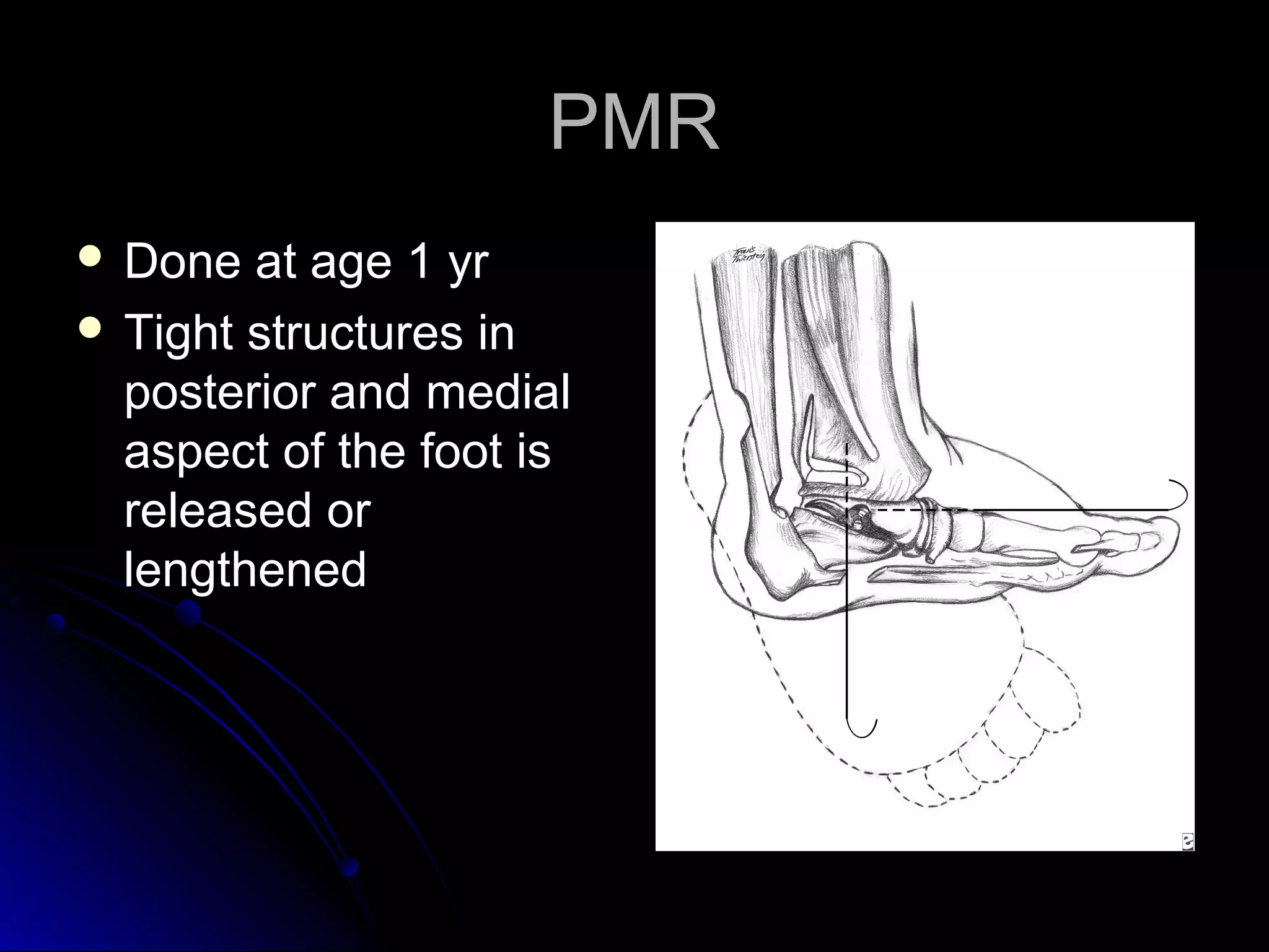 Is Your Child'S Foot Turned In? Understanding Equino Varus - s7ssxiq