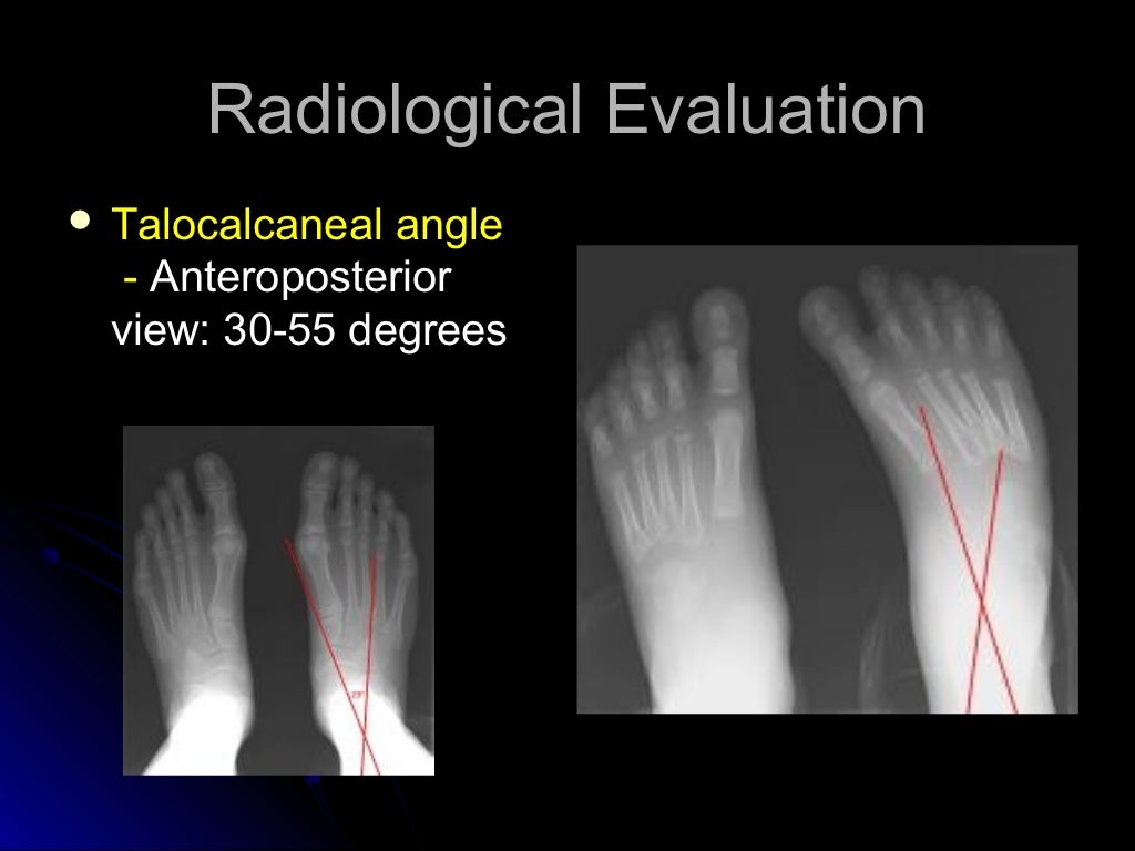 CONGENITAL TALIPES EQUINO VARUS