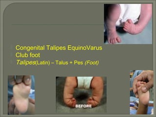  Congenital Talipes EquinoVarus
 Club foot
 Talipes(Latin) – Talus + Pes (Foot)
 