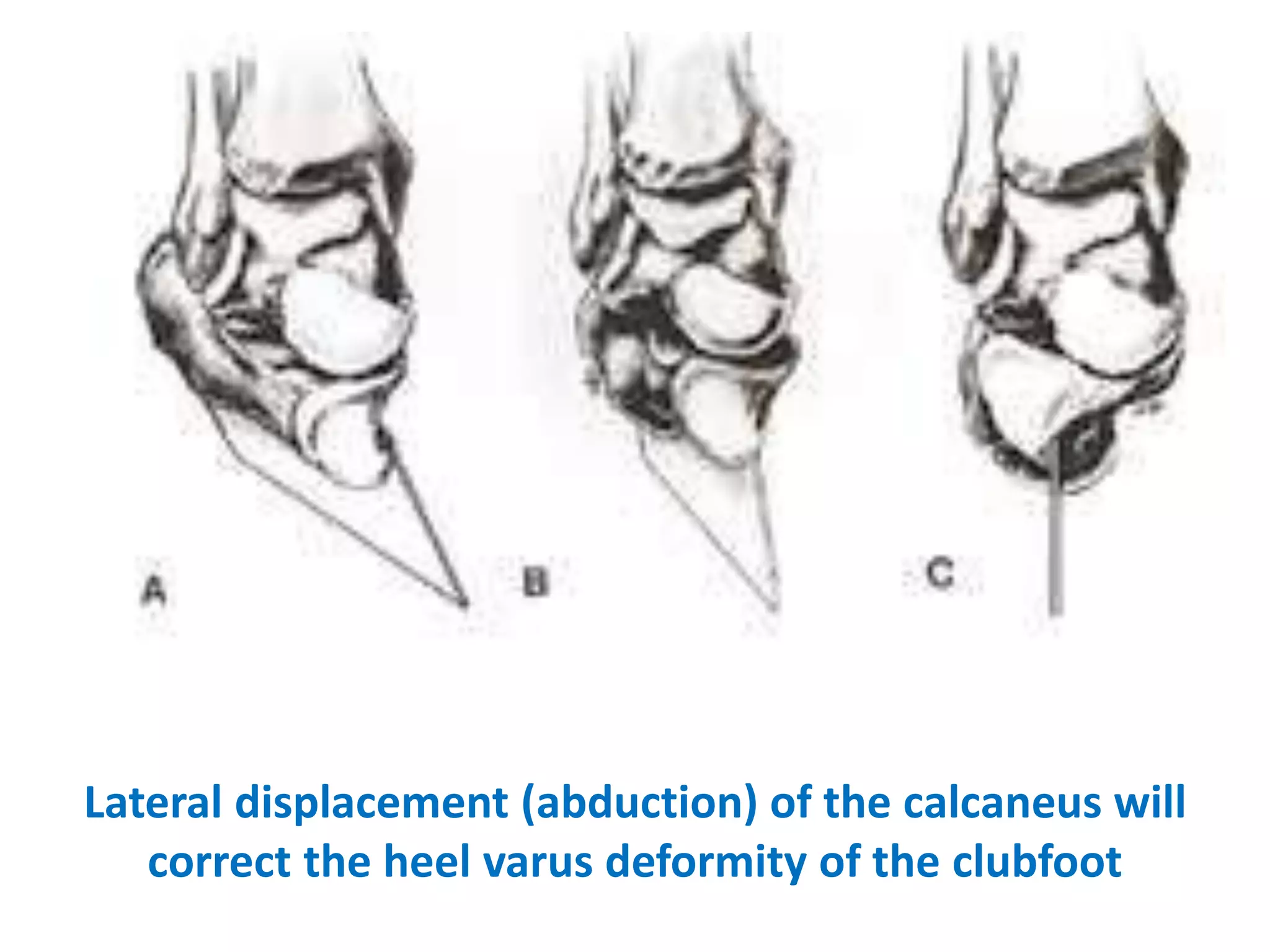Lateral displacement (abduction) of the calcaneus will
correct the heel varus deformity of the clubfoot
 
