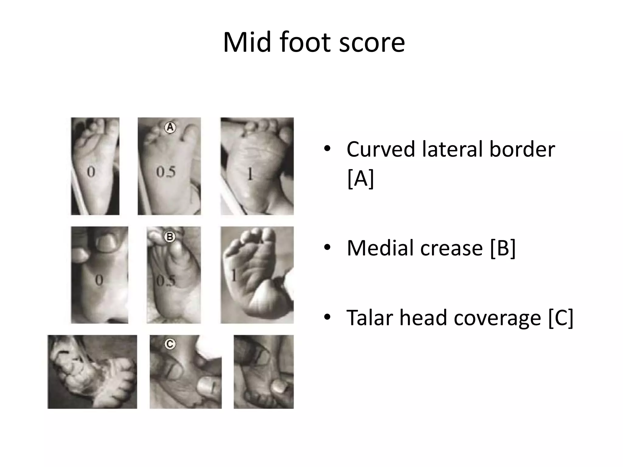 Mid foot score
• Curved lateral border
[A]
• Medial crease [B]
• Talar head coverage [C]
 