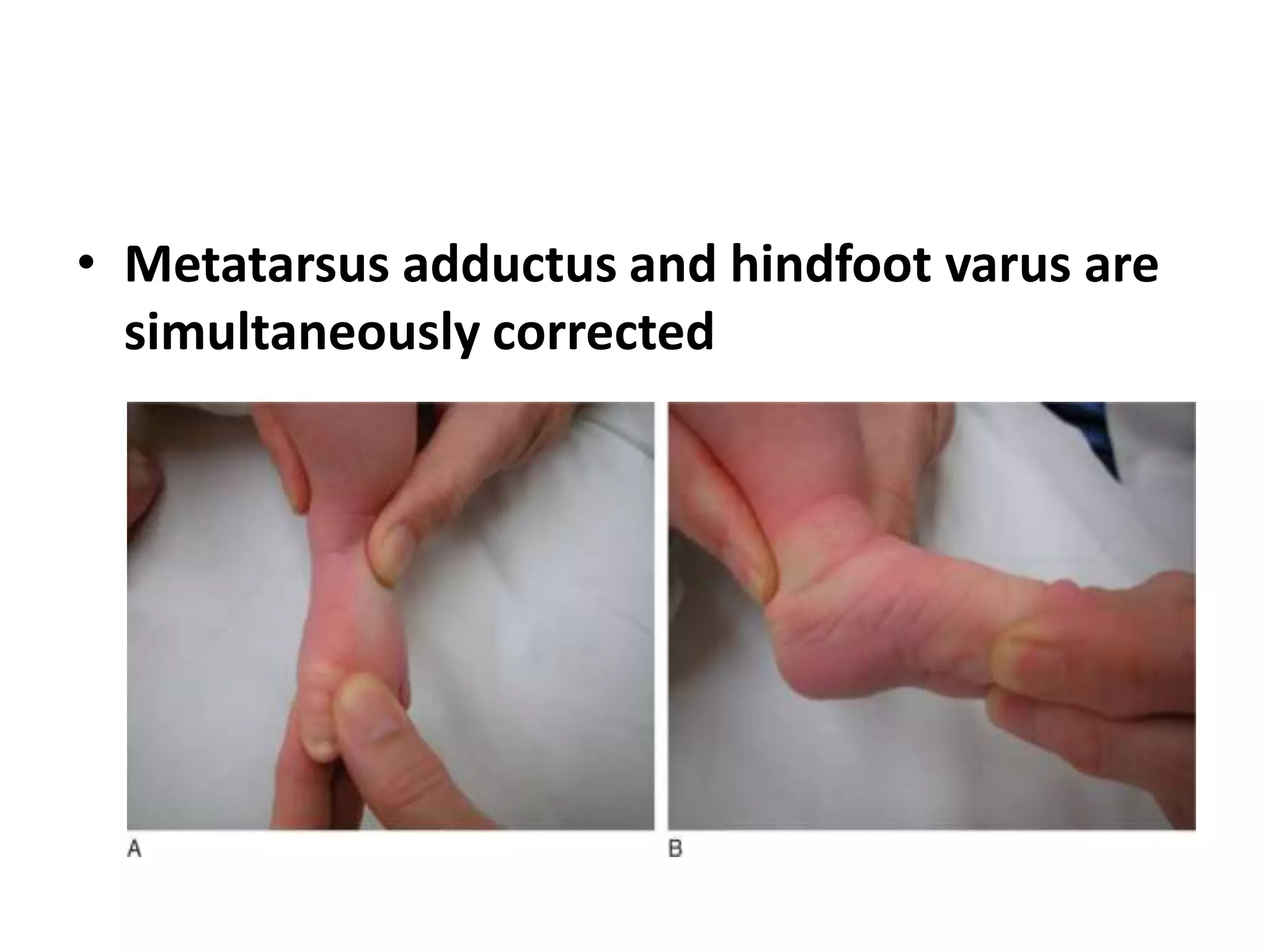 • Metatarsus adductus and hindfoot varus are
simultaneously corrected
 