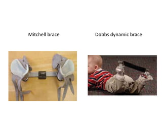 Mitchell brace Dobbs dynamic brace
 