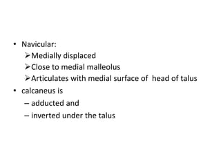 • Navicular:
Medially displaced
Close to medial malleolus
Articulates with medial surface of head of talus
• calcaneus is
– adducted and
– inverted under the talus
 
