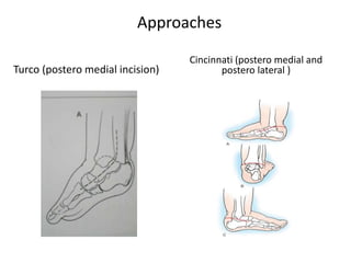 Approaches
Turco (postero medial incision)
Cincinnati (postero medial and
postero lateral )
 