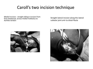 Caroll’s two incision technique
Medial incision - straight oblique incision from
first metatarsal, across medial malleolus to
Achilles tendon
Straight lateral incision along the lateral
subtalar joint antr to distal fibula
 
