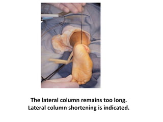 The lateral column remains too long.
Lateral column shortening is indicated.
 
