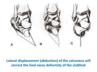 Lateral displacement (abduction) of the calcaneus will
correct the heel varus deformity of the clubfoot
 