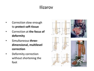 Ilizarov
• Correction slow enough
to protect soft tissue
• Correction at the focus of
deformity
• Simultaneous three-
dimensional, multilevel
correction
• Deformity correction
without shortening the
foot
 