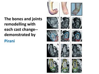The bones and joints
remodelling with
each cast change--
demonstrated by
Pirani
 