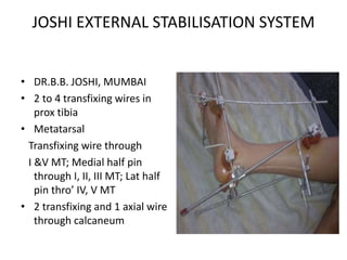 JOSHI EXTERNAL STABILISATION SYSTEM
• DR.B.B. JOSHI, MUMBAI
• 2 to 4 transfixing wires in
prox tibia
• Metatarsal
Transfixing wire through
I &V MT; Medial half pin
through I, II, III MT; Lat half
pin thro’ IV, V MT
• 2 transfixing and 1 axial wire
through calcaneum
 