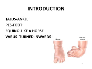 INTRODUCTION
TALUS-ANKLE
PES-FOOT
EQUINO-LIKE A HORSE
VARUS- TURNED INWARDS
 