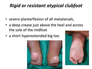 Rigid or resistant atypical clubfoot
• severe plantarflexion of all metatarsals,
• a deep crease just above the heel and across
the sole of the midfoot
• a short hyperextended big toe.
 