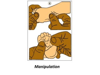 Manipulation
 