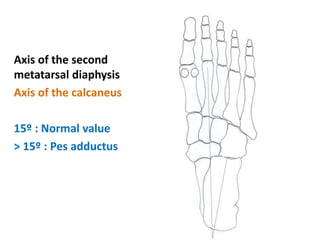Axis of the second
metatarsal diaphysis
Axis of the calcaneus
15º : Normal value
> 15º : Pes adductus
 