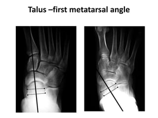 Talus –first metatarsal angle
 