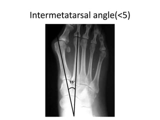 Intermetatarsal angle(<5)
 