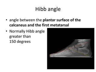 Hibb angle
• angle between the plantar surface of the
calcaneus and the first metatarsal
• Normally Hibb angle is
greater than
150 degrees
 