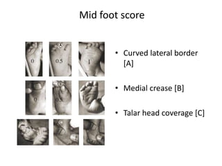 Mid foot score
• Curved lateral border
[A]
• Medial crease [B]
• Talar head coverage [C]
 