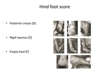 Hind foot score
• Posterior crease [D]
• Rigid equinus [E]
• Empty heel [F]
 