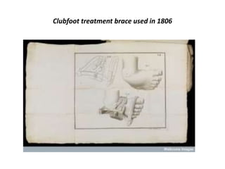 Clubfoot treatment brace used in 1806
 