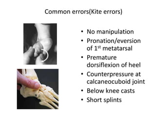 Common errors(Kite errors)
• No manipulation
• Pronation/eversion
of 1st metatarsal
• Premature
dorsiflexion of heel
• Counterpressure at
calcaneocuboid joint
• Below knee casts
• Short splints
 