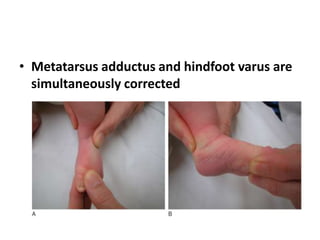 • Metatarsus adductus and hindfoot varus are
simultaneously corrected
 