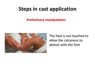 Steps in cast application
Preliminary manipulation
The heel is not touched to
allow the calcaneus to
abduct with the foot
 