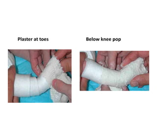 Plaster at toes Below knee pop
 