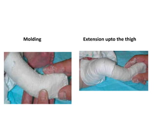 Molding Extension upto the thigh
 