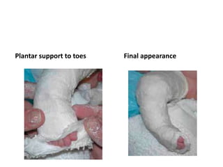 Plantar support to toes Final appearance
 