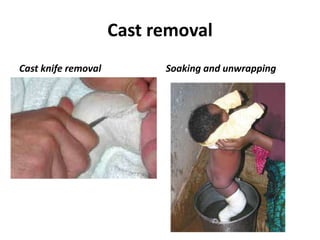Cast removal
Cast knife removal Soaking and unwrapping
 